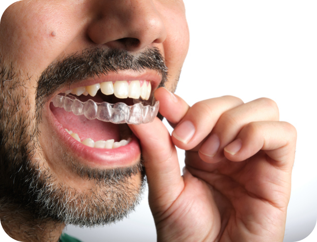 adult with Invisalign aligner