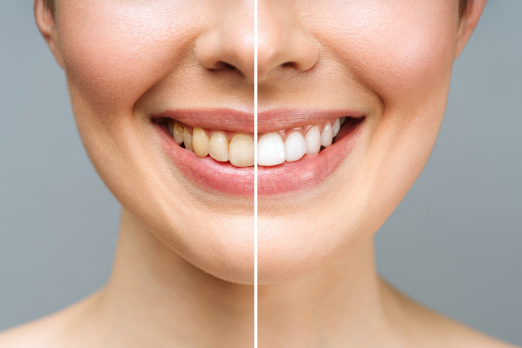 Comparison of a smile before and after teeth whitening when it is multiple shades brighter