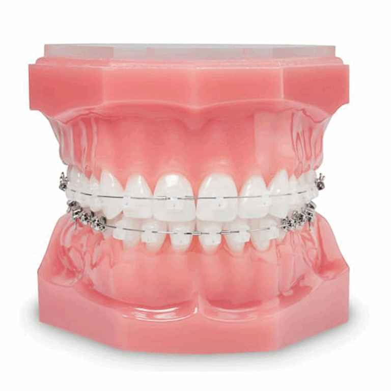 Close up of a realistic dental model made of hard plastic with clear braces attached