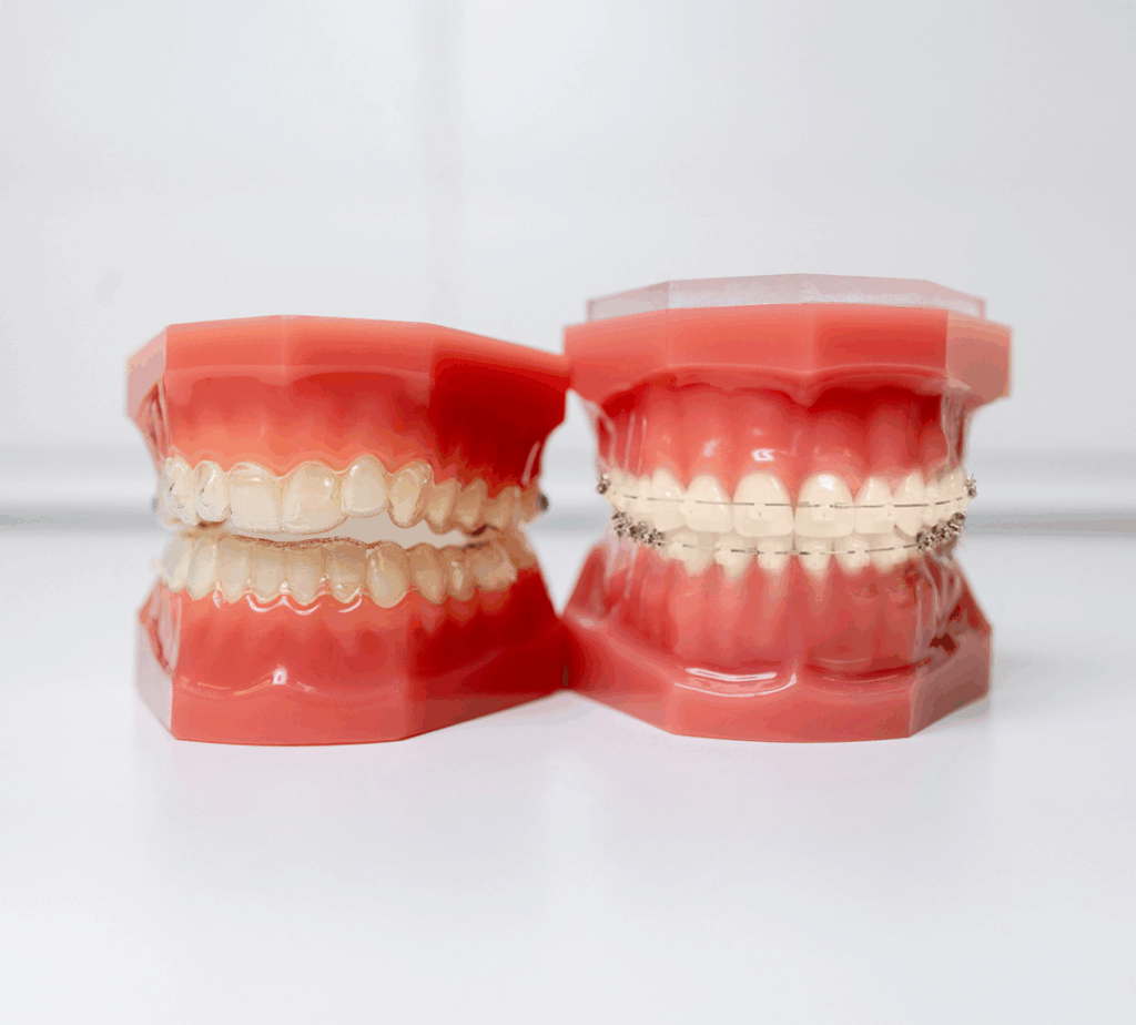 Two hard plastic dental models, one with clear aligners Invisalign and one with clear braces