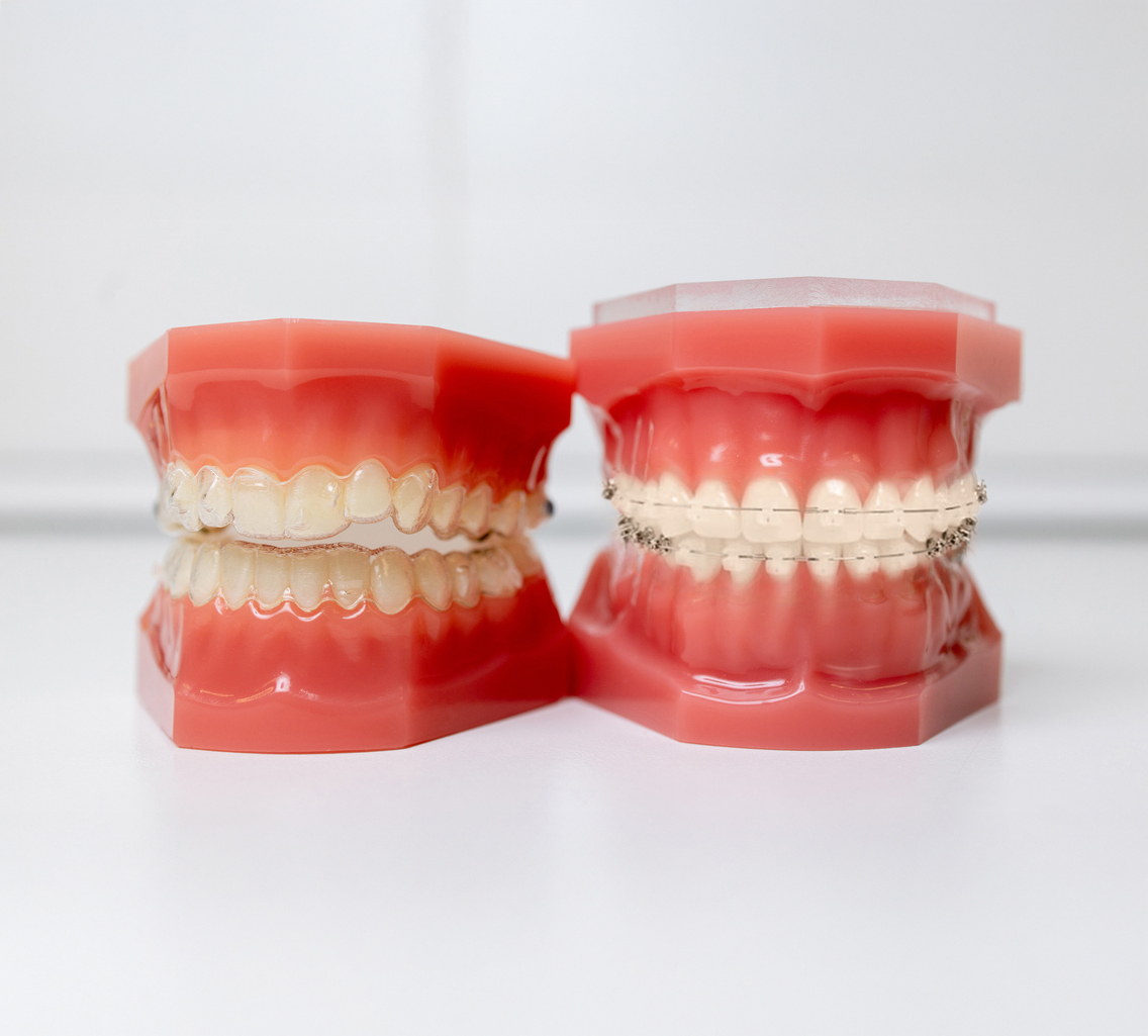 Two hard plastic dental models, one with clear aligners Invisalign and one with clear braces