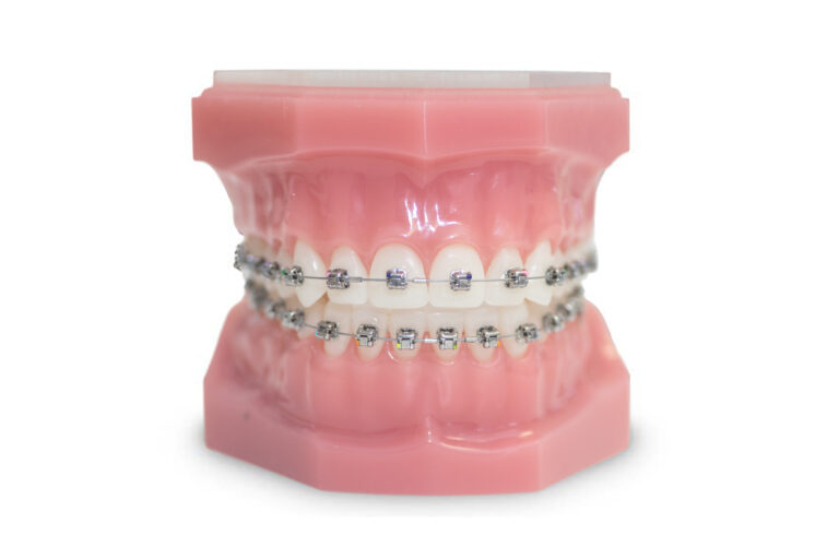 Close up of a realistic dental model made of hard plastic with metal braces attached
