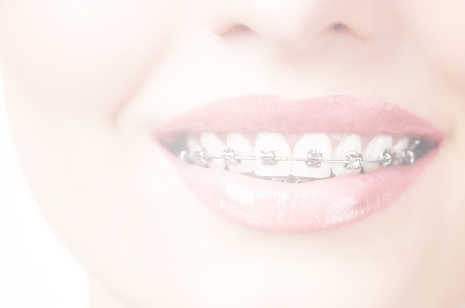 Slightly translucent close up of the smile of a young woman with metal braces